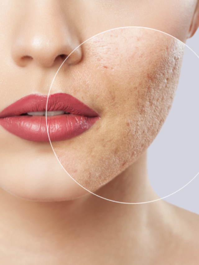 get rid of open pores
